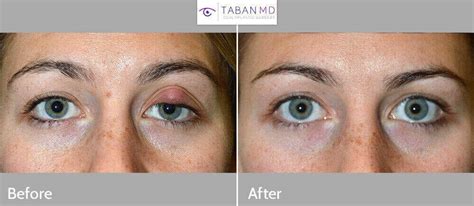 Chalazion For 6 Months Chalazion Treatment Surgery Images Removal