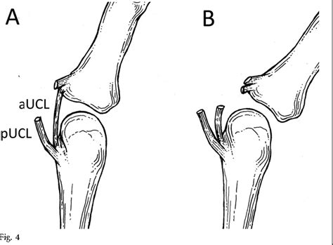 Figure 1 From Ulnar Collateral Ligament Injuries Of The Thumb Phalangeal Translation During