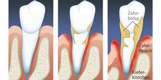 Parodontitis Symptome Diagnose Therapie Vorbeugen Apotheken Umschau