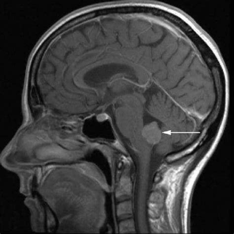 Image Of The Primary Tumor An Intraventricular Atypical Choroid Plexus