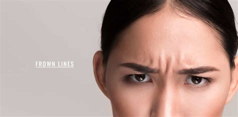 Frown Lines - Ensoul Medical Clinic