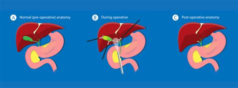 Laparoscopic Cholecystectomy Anatomy