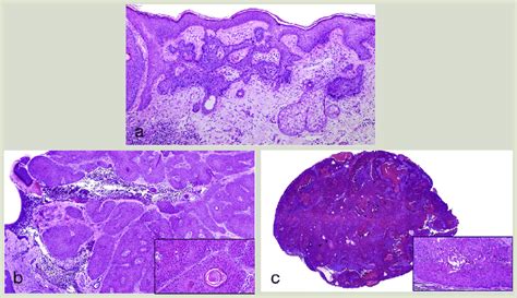 A Tumour Of The Follicular Infundibulum Anastomosing Epithelial