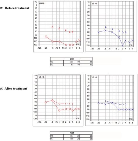 A Audiograms Before Treatment B Audiograms After Treatment Download Scientific Diagram