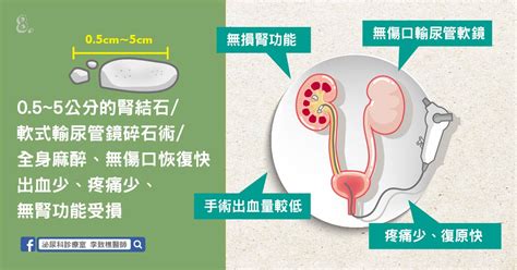 李致樵 泌尿科診療室 【泌尿科 李致樵醫師】尿路結石 腎結石輸尿管結石 治療篇