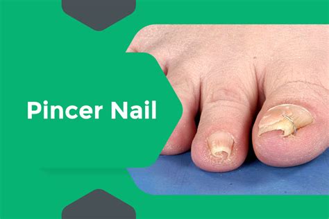 Pincer Nail