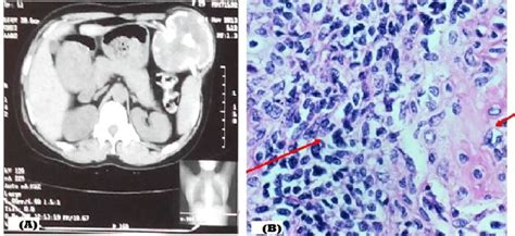 (A): CT Scan of tumor; (B): HP showing clear cell chondrosarcoma ...