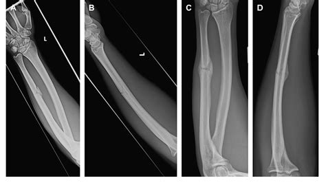 Pdf Management Of Isolated Ulnar Shaft Fractures Semantic Scholar