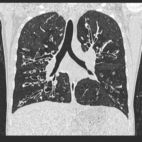 Radiology Bronchiectasis