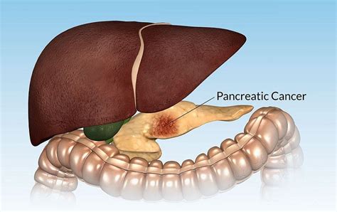 10 Warning Signs Of Pancreatic Cancer You Should Never Ignore R