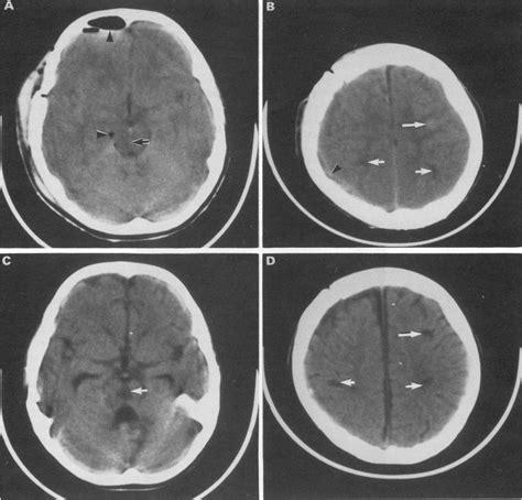 A Computed Tomogram Showing An Example Ofdiffuse Axonal Injury A Download Scientific Diagram