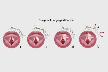 Throat Cancer: Types Causes Symptoms Diagnosis and Treatments