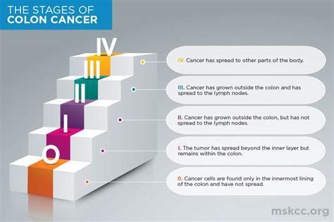 Colon Cancer Stages 0, 1, 2, 3, 4 | Memorial Sloan Kettering Cancer Center