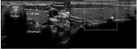 The Role Of Ultrasound In The Differential Diagnosis Of Hypothyroidism