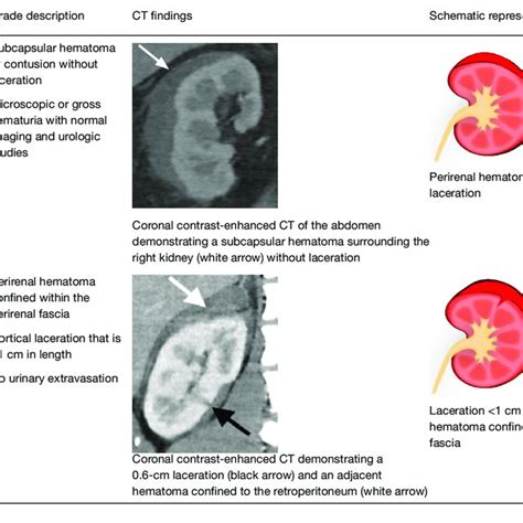 Adaptation Of The Aast Renal Injury Grading System With An Emphasis On