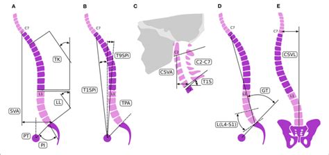 Spinal Alignment Evaluation Sagittal Spino Pelvic Parameters A C