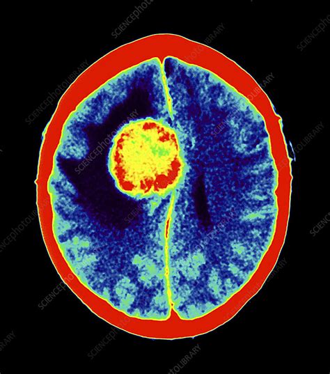 Meningioma Brain Tumour Ct Scan Stock Image M Science