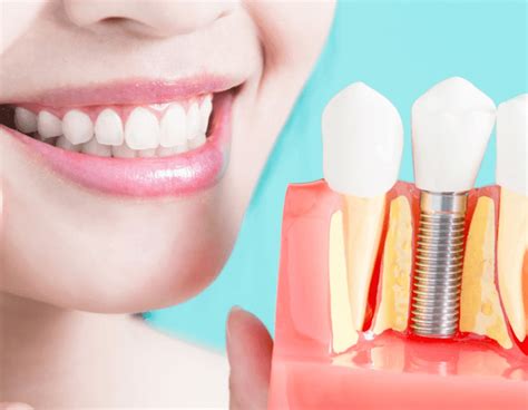 Công nghệ trồng răng Implant AI Giải pháp hiện đại an toàn và tiên tiến