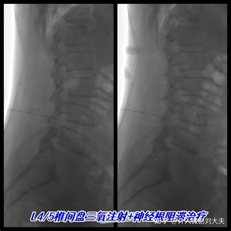 椎间盘源性腰痛微创介入治疗 知乎