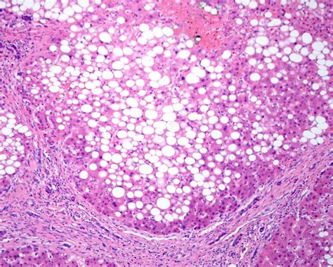 Cirrhosis And Steatosis Of The Liver Light Micrograph Stock Image