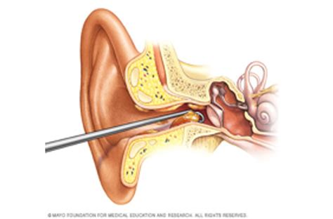 Bobby Pin To Remove Ear Wax At Raymond Workman Blog