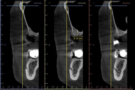 Lateral Sinus Floor Augmentation With Cerabone With 4 Year Follow Up