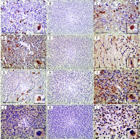 Mmunohistochemical Double Staining Of Cd Foxp And Simple Staining Of