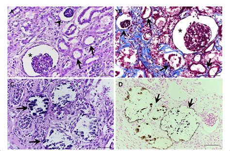 Ab The Interstitial Fibrosis Surrounding The Segmental Nephrons And
