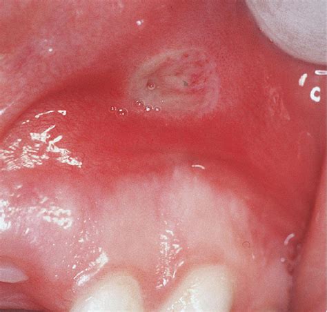 Recurrent Oral Ulceration Aphthous Like Ulcers In Periodic Syndromes Oral Surgery Oral