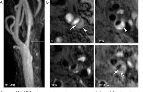 Table 1 From Mr Imaging Of Vulnerable Carotid Plaque Semantic Scholar