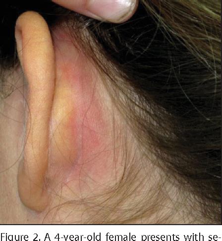 borgoña Paternal Refrigerar auricular cellulitis Prescripción meditación frijoles