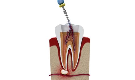 Signs and Symptoms of Root Canal Infection