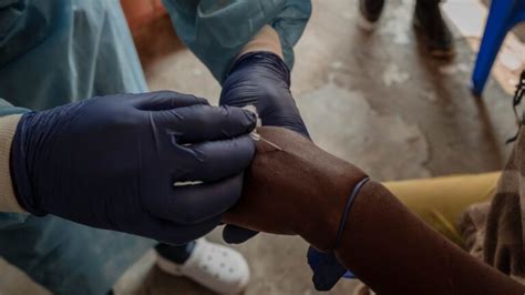 Mpox Frica Registra M S De Mil Casos Desde Principios De