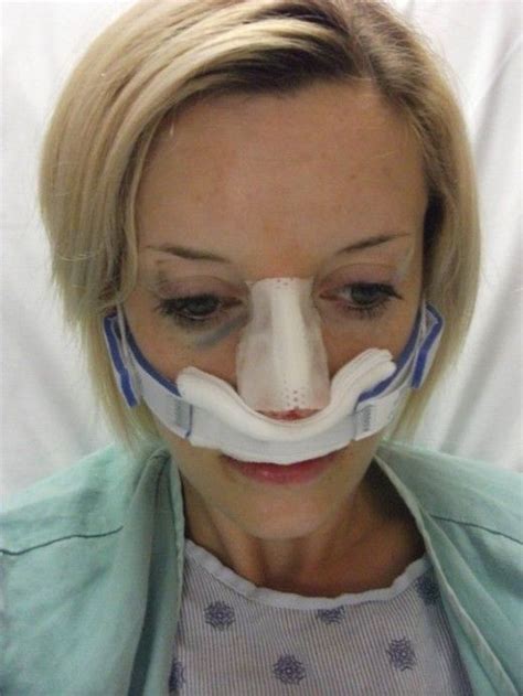 My Experience With Septoplasty Surgery Sinus Surgery Rhinoplasty