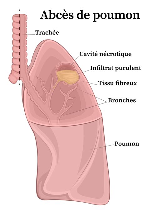 Abc S Du Poumon Causes Cons Quences Et Traitements Information