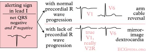 How To Read An Ecg Wikidoc