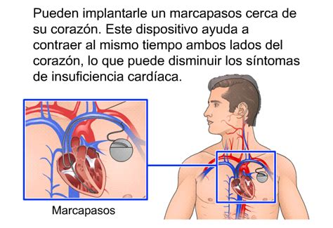 Patedu Insuficiencia Card Aca Congestiva