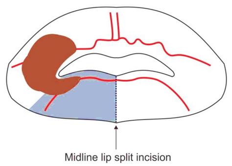 135 Surgical Resection Of Cancer Of The Buccal Mucosa Medicine