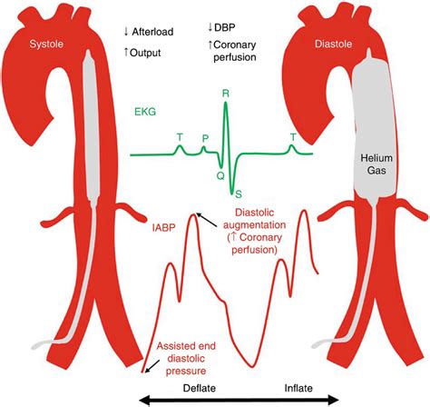 Mechanism Of Action Of An Intra Aortic Balloon Pump The Device