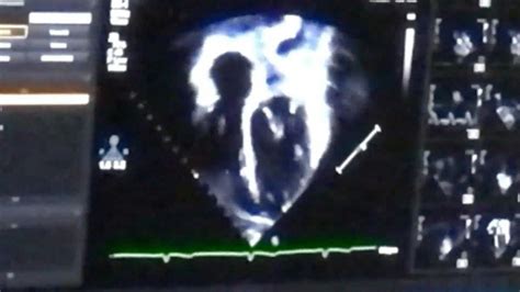 Cardiac Ultrasound - Practical Neurology