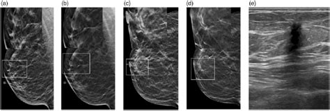 A Synthetic 2d Mammogram Mediolateral Oblique View Right Breast