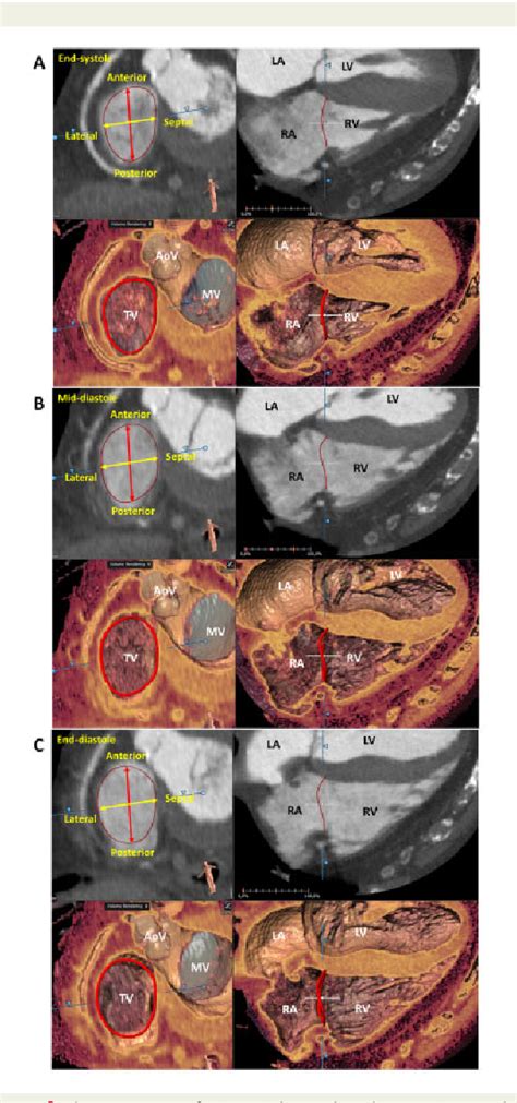 Figure 1 From Association Between Computed Tomography Derived Tricuspid Annular Dimensions And