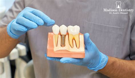 5 Things You Should Know About Dental Implant Treatment