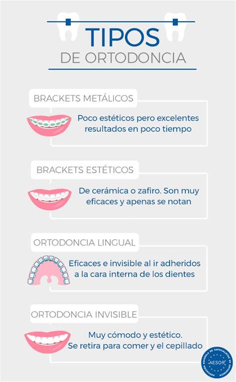 La Mejor Ortodoncia Invisible Cu L Elegir Cl Nica Dental Gomeza