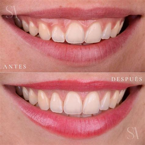 Como Se Ponen Las Carillas Dentales Sin Tallado Sergi Arranz Smile Studio