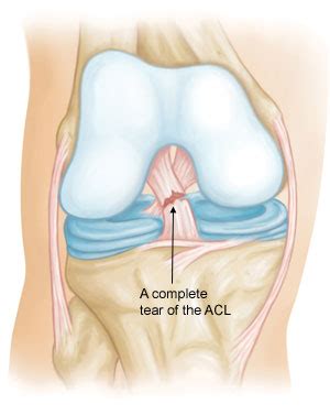 Acl Tears Mark W Maffet M D