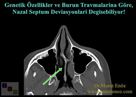 Genetik Özellikler ve Burun Travmalarına Göre Nazal Septum