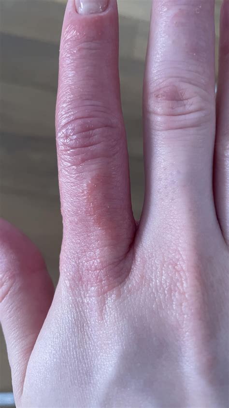 Recurring Rashes And Swelling On Face And Fingers For Months No Creams Helping Ive Also Tried