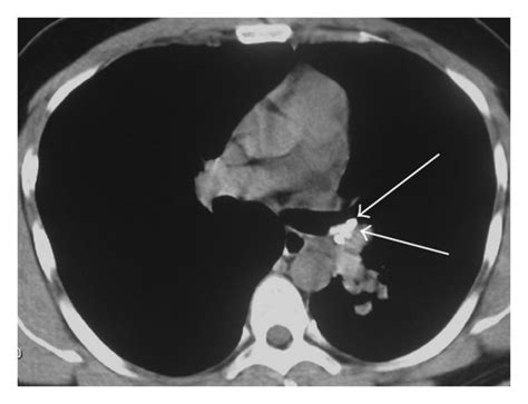 Hrct Scans With Mediastinal Window A D Demonstrated A Mass With Download Scientific Diagram