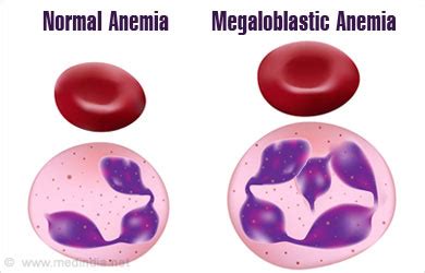 Pathophysiology Of Megaloblastic Anemia